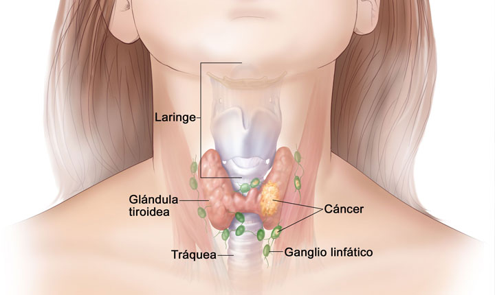 Cáncer de tiroides - Conac